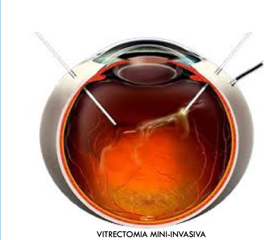 vitrectomia-distacco-retina-007